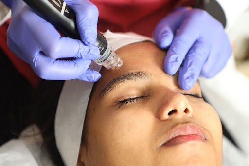 Microneedling treatment at Yuga's Aesthetic Clinic