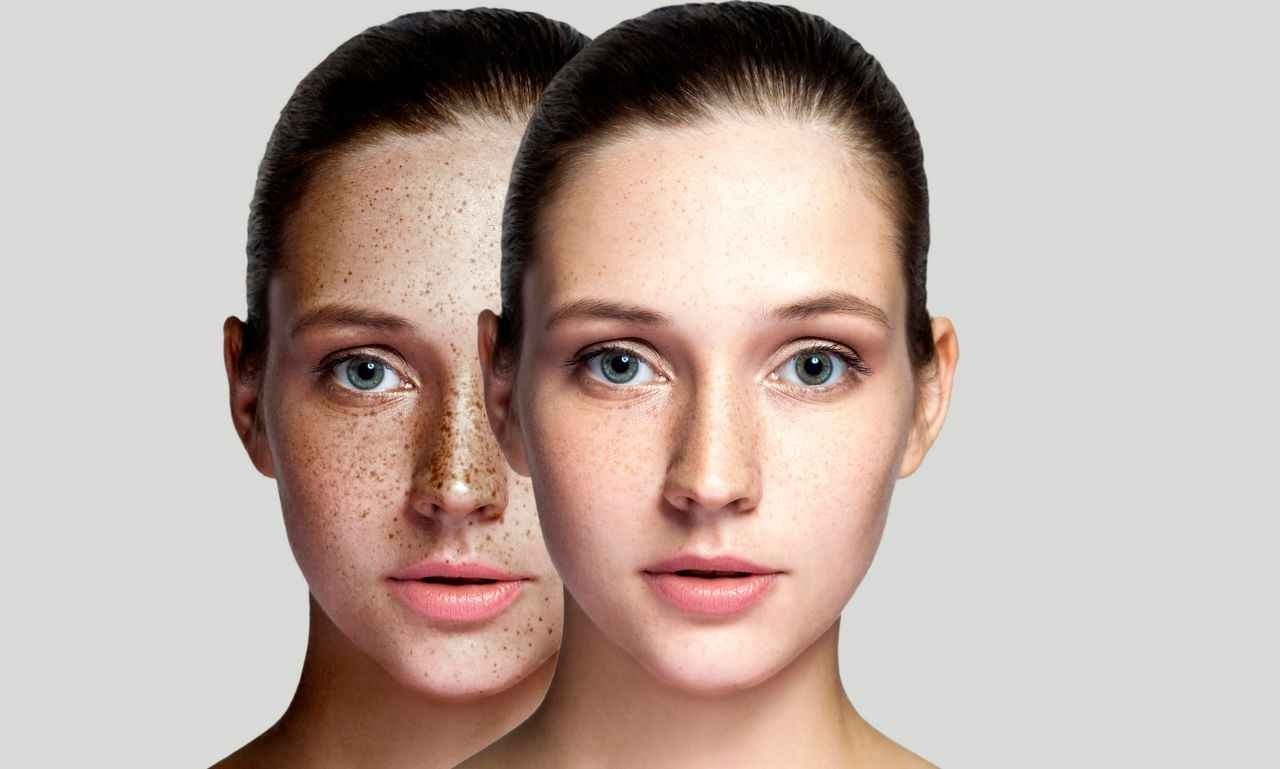 Before and after appearance of facial freckles