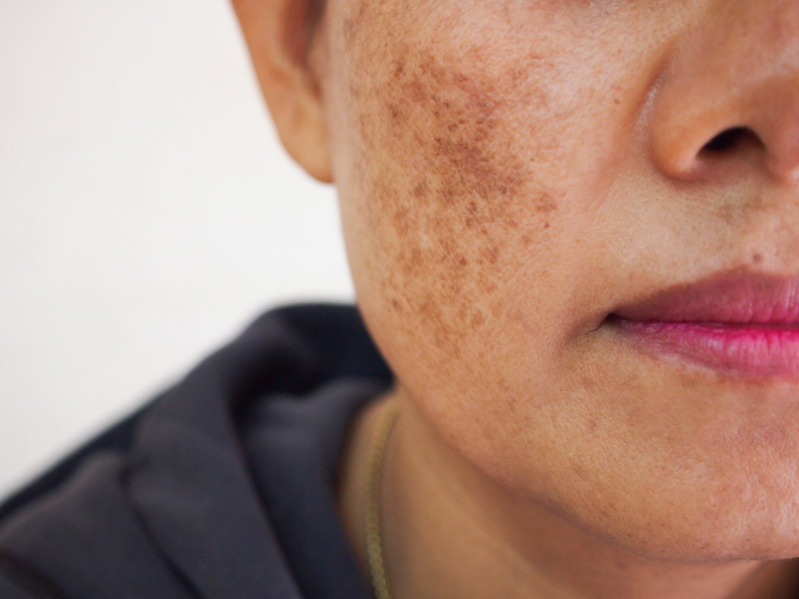 Facial skin showing melasma pigmentation