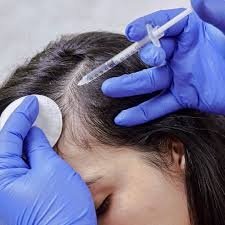 Hair mesotherapy treatment administered to the scalp