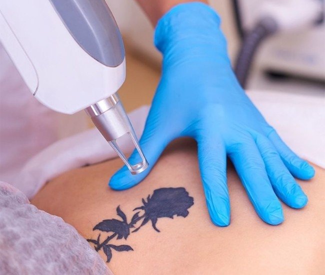 Laser tattoo removal treatment performed by a clinician